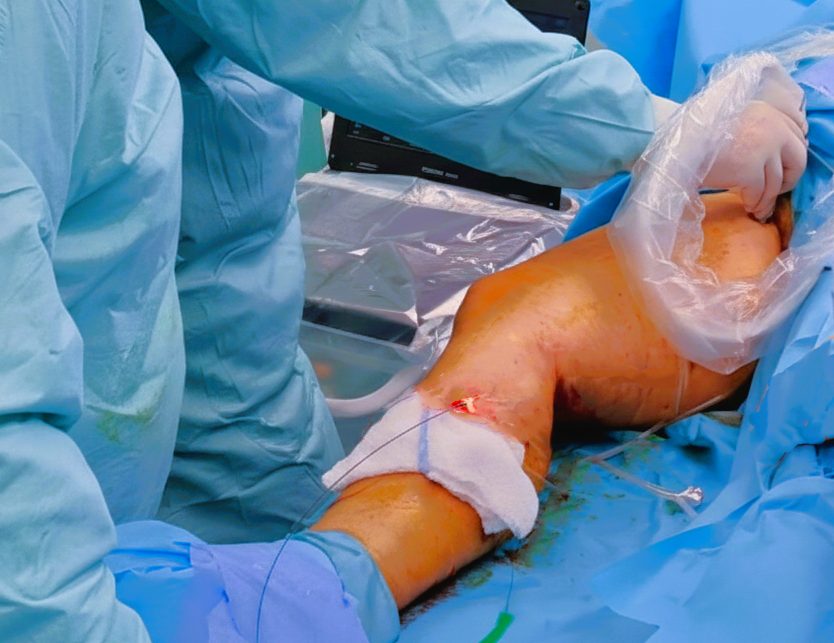 Ενδοφλεβική θεραπεία κιρσών με Laser - Δημήτριος Λιακόπουλος